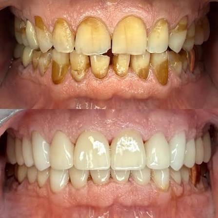 Happy Patient - Smile Makeover Uttam Nagar New Delhi